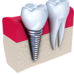 Implantologie dentară